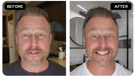 Deep Wrinkles & Lines Before After