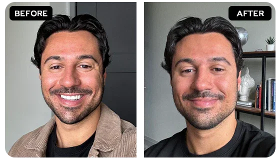 Sagging Jawline & Jowls Before After