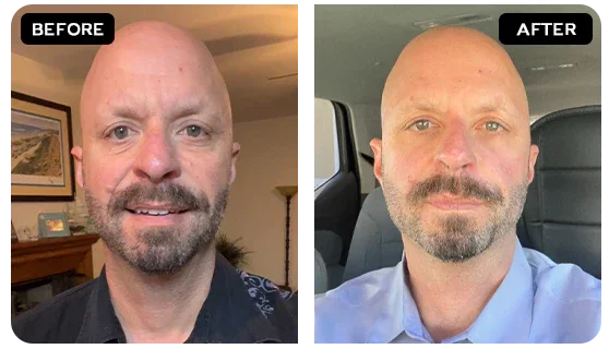 Eye Bags & Dark Circles Before After