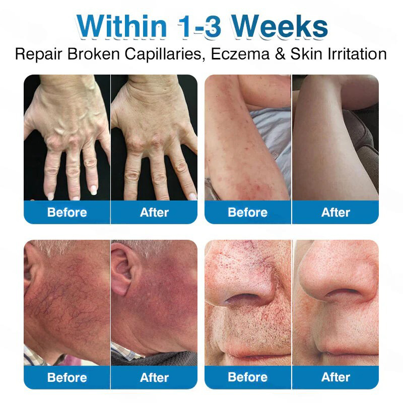 🏅🏃OUR+ Microneedle Patch Roll⚡Instant Relief, Long-Term Results