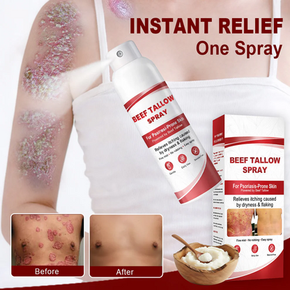 OUR+™ Beef Tallow Spray for Itchy, Flaky Psoriasis Skin