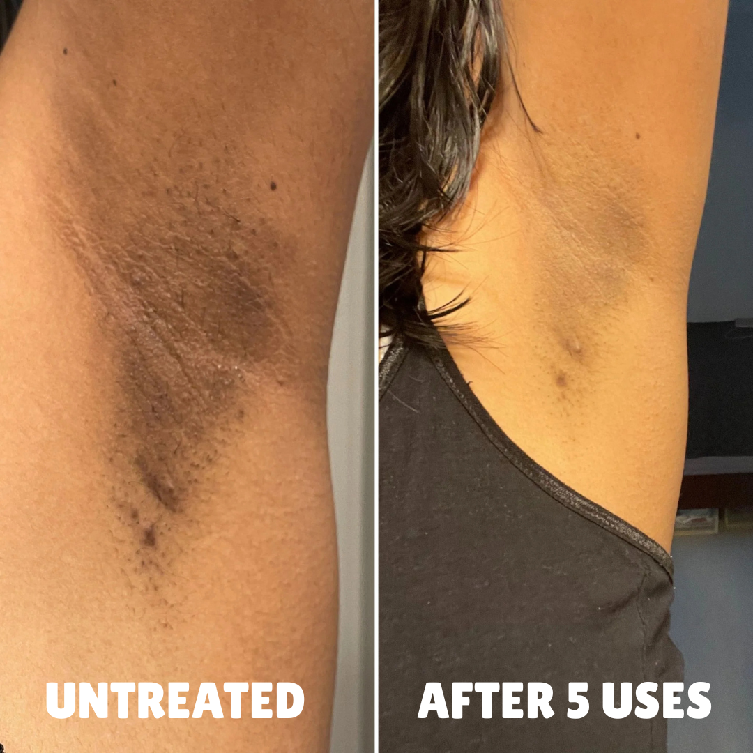 Cellular-Level Delivery Triple Acid Complex For Hyperpigmentation