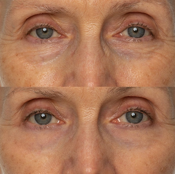 Fine line appearance result example