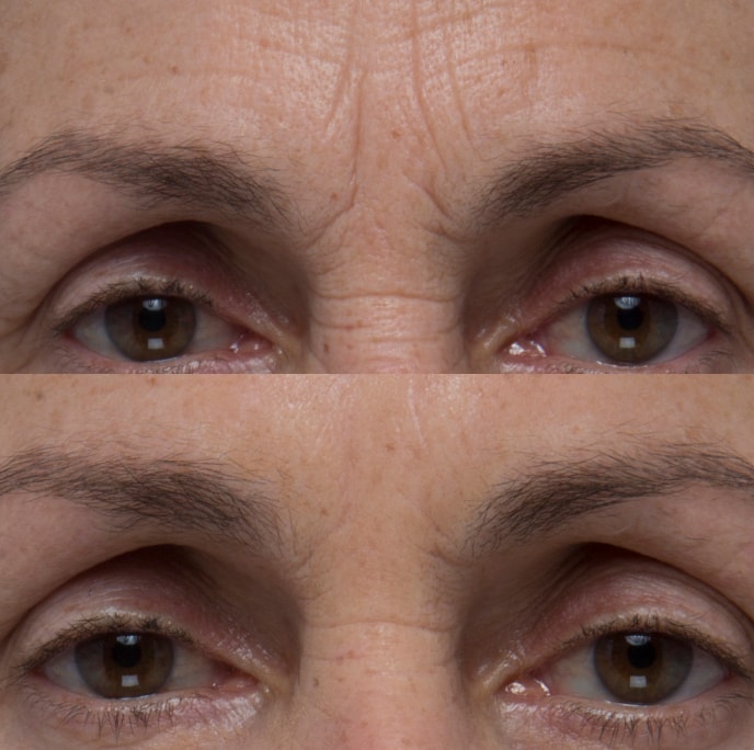 Frown line appearance result example