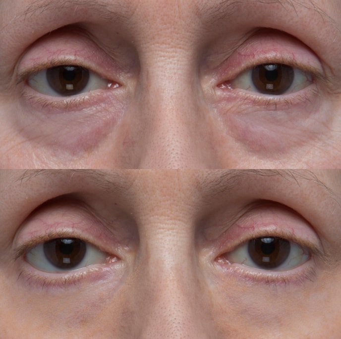 Under-eye shadow appearance result example
