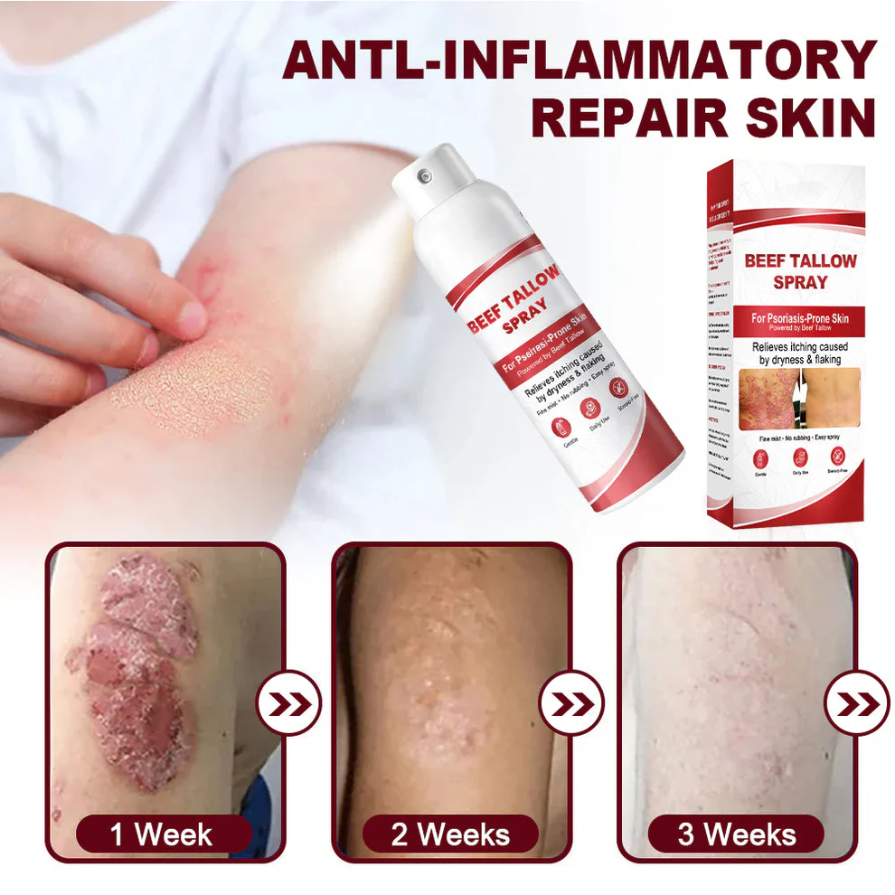 OUR+™ Beef Tallow Spray for Itchy, Flaky Psoriasis Skin