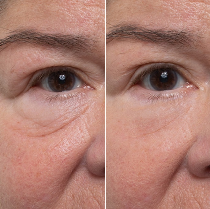 Eye bag appearance result example