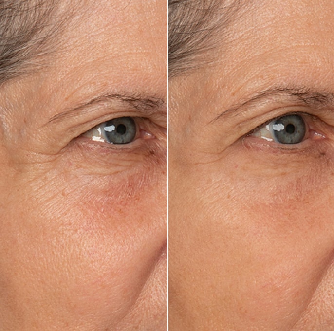 Fine line and wrinkle appearance result example