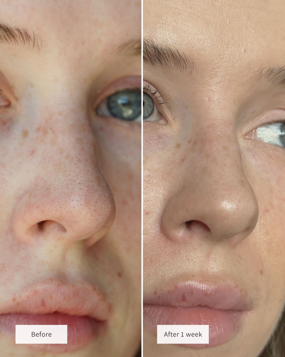 Hydrogel Nose Patches
