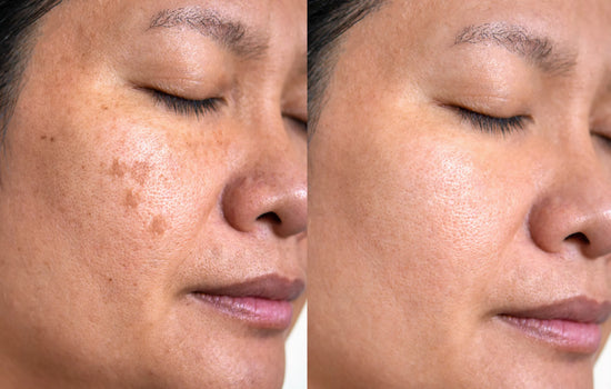 Las-Vegas-Acne-Scar-Treatment-scaled.jpg