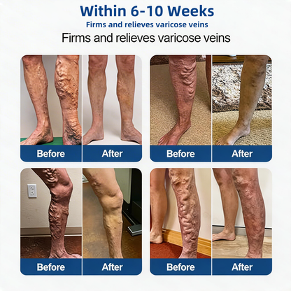 Vein ContourMicroneedle Patch with AdvancedDiosmin & Hesperidin Delivery 🌿 7-Day Visible Results for VaricoseVeins