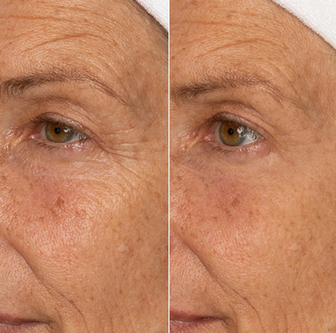 Crow's feet appearance result example