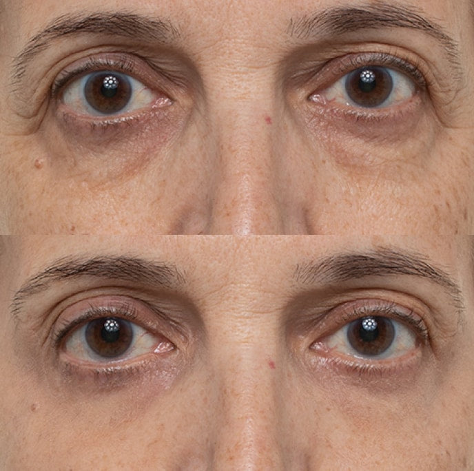 Dark circle appearance result example