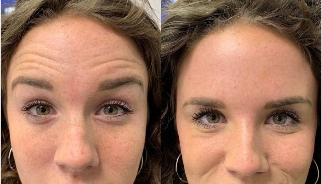 pt-1a6925699c0b-How-To-Get-Rid-of-Forehead-Lines-and-Wrinkles.jpg