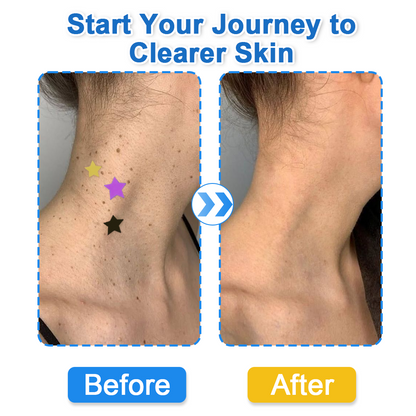 2-in-1 Microneedle & Hydrocolloid Star Patch 🌟 | Acne, Blackheads, Skin Tags & Raised Blemishes Remover 💫 | 6 Colors Pimple Patch for Face & Neck 🌸 | Invisible Star Zit Stickers ✨