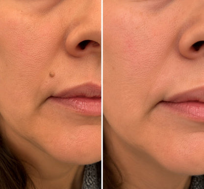 Tryourplus® 2-in-1 Microneedle & Hydrocolloid Patch 🌿 Invisible Face & Body Patches for Raised Moles, Acne, Flat Warts & Skin Tags - Helps Improve the Appearance of Wrinkles, Scars & Blemishes